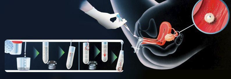 İntra-Uterin İnseminasyon IUI Aşılama Nedir?