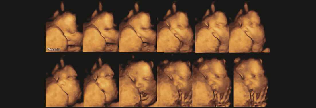 4 Boyutlu USG ile Anne Karnındaki Bebeğin izlenmesi