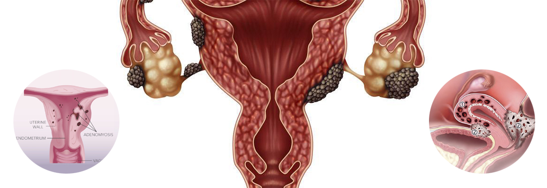 Endometriozis (Çikolata Kisti) Nedir?